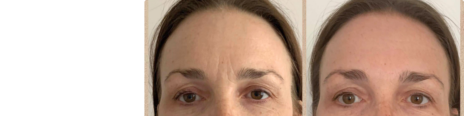 Side-by-side images showing the face before and after a Face by Greethel lifting massage, highlighting lifted contours and smoother skin.